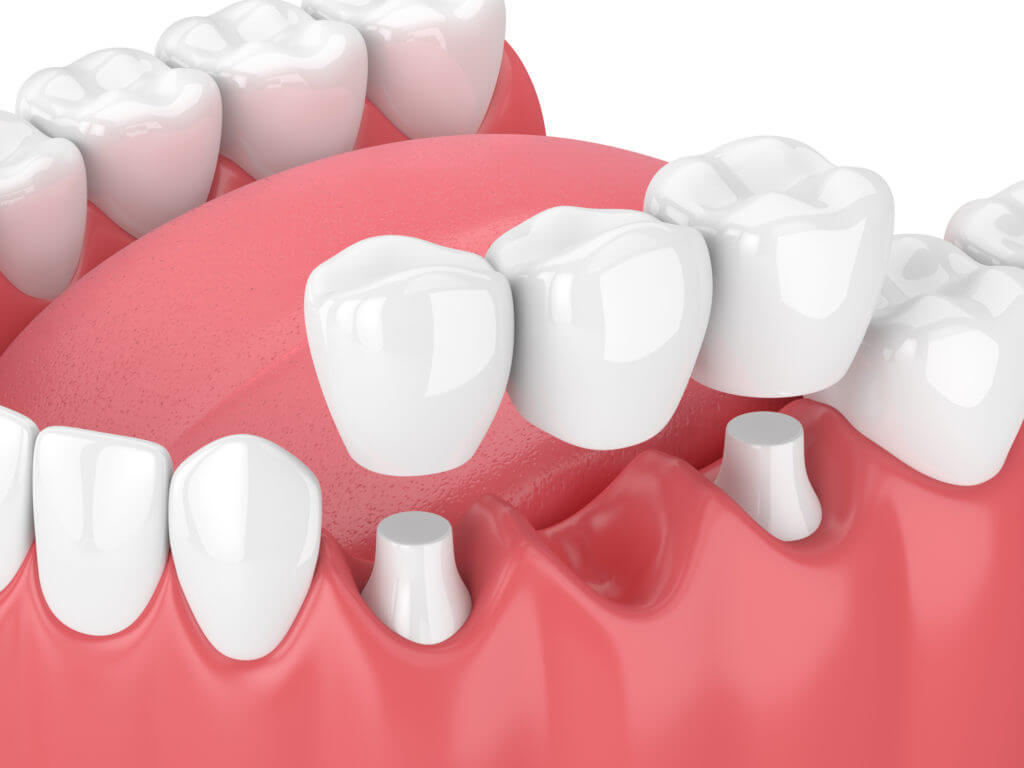 dental bridge cerritos